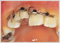 外傷歯の脱落への対応
